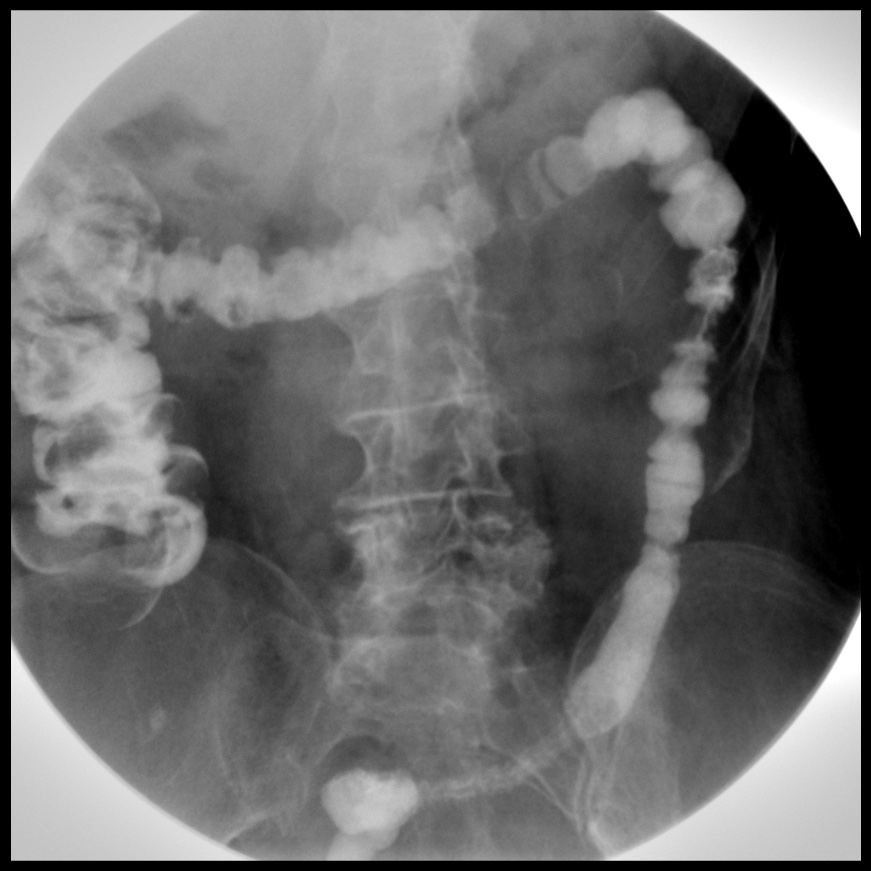 Barium Enema