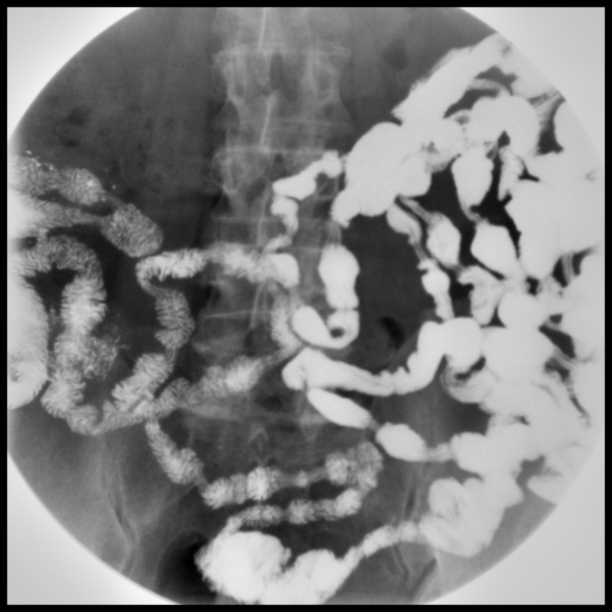 Barium meal follow through