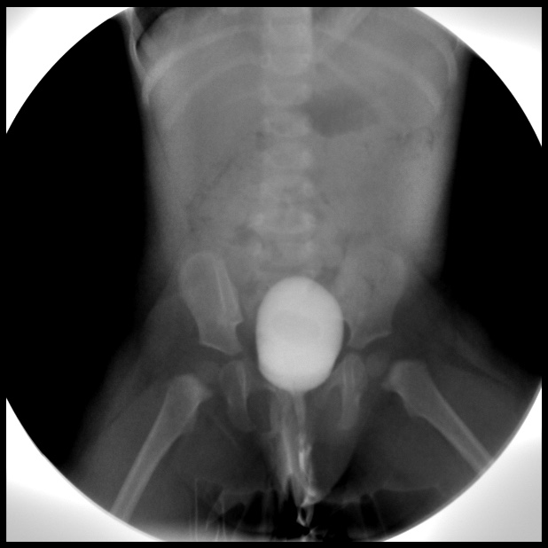 Micturating Cystourethrogram